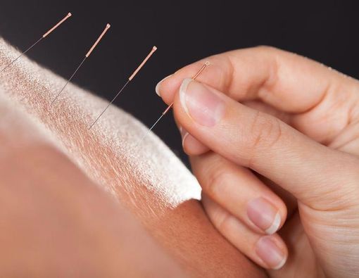 Terapi Akupunktur untuk Radang Sendi
