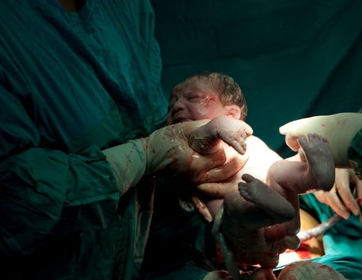 Mengenal Kelebihan dan Kekurangan Metode Persalinan ERACS