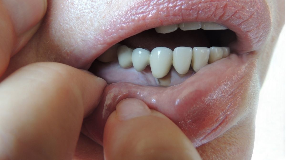 Apakah Periodontitis Bisa Menular Melalui Ciuman?