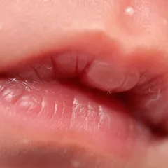 Mengenal Kondisi Lip Blister atau Suck Blister pada Bayi