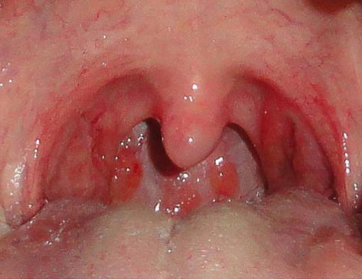 Kenali Radang Tenggorokan yang Bisa Merusak Jantung dan Ginjal