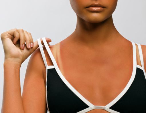 Obat Baru untuk Sunburn