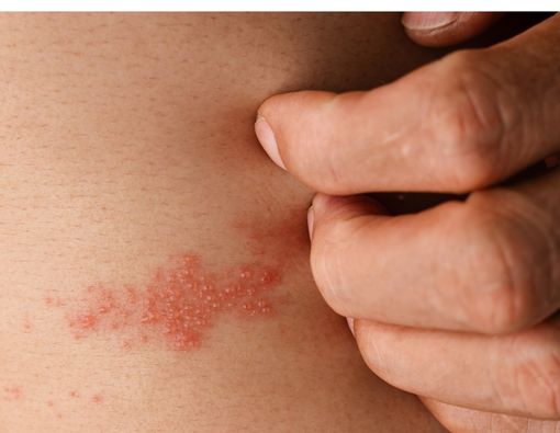 Mengenal Bakteri "Pemakan Daging" yang Sedang Marak di Jepang