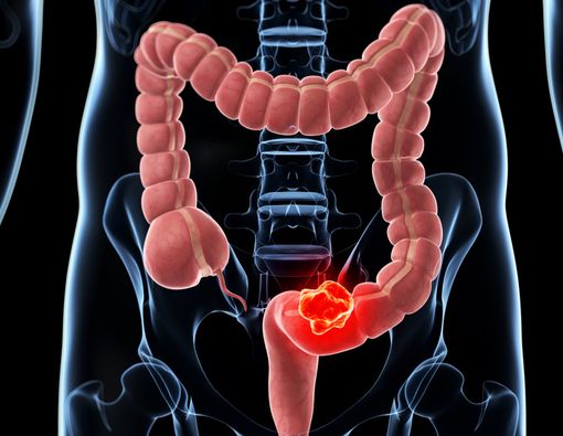 Kenali Penyebab Kanker Usus yang Dialami Eks KSAD George Toisutta