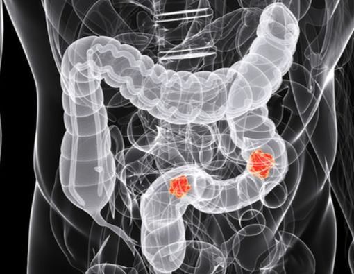 Waspadai 5 Gejala Kanker Kolon Ini