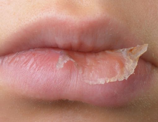 Cegah Bibir Kering Selama Puasa dengan 4 Langkah Ini