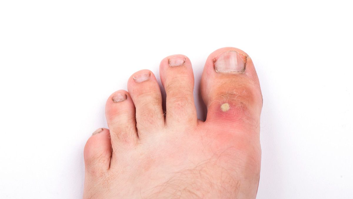 Cara Tepat Mengobati Bisul pada Penderita Diabetes