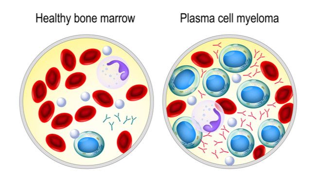 Gejala Multiple Myeloma yang Perlu Anda Tahu