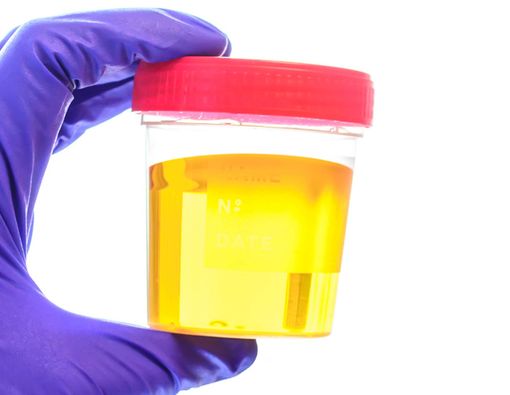 Maple Syrup Urine Disease, Saat Air Kencing Terasa Manis