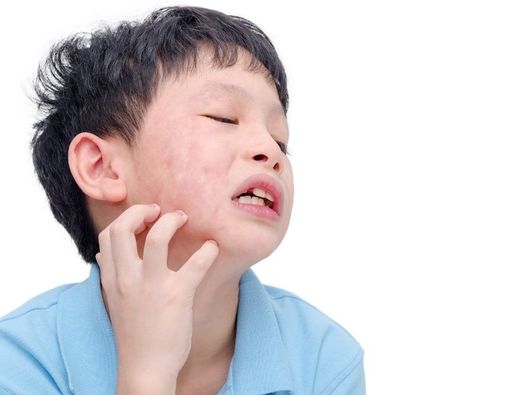 Pengobatan Alami untuk Anak Alergi