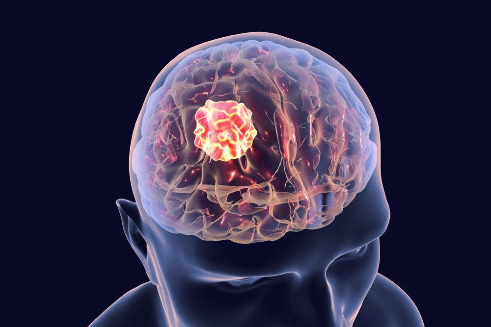 Adakah Hubungan antara Kanker Otak dan Gegar Otak?