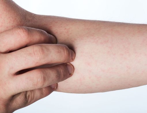 Fakta di Balik Campak pada Orang Dewasa