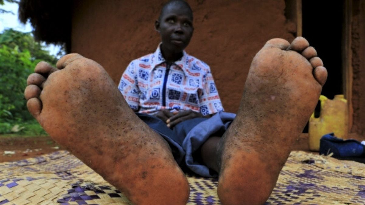 Penyakit Jiggers (Kutu Kecil) Bisa Mengakibatkan Kematian, Benarkah