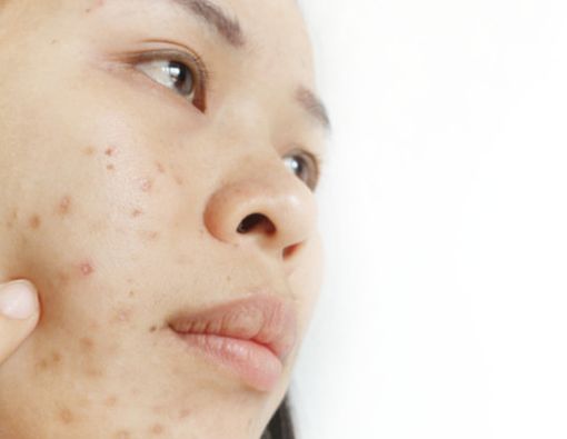 14 Cara Ampuh Menghilangkan Flek Hitam Bekas Jerawat