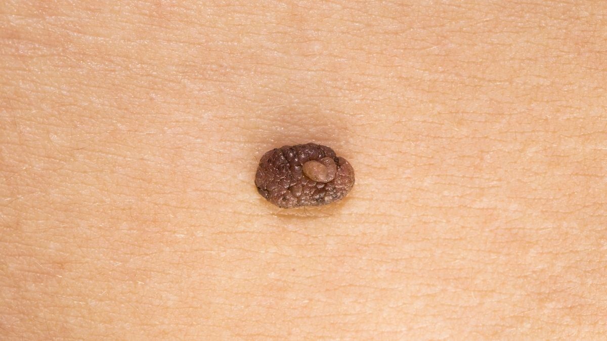 Deretan Cara Menghilangkan Tahi Lalat Secara Alami