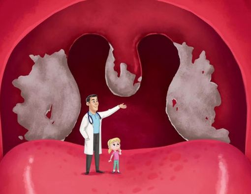 Gejala Awal Difteri yang Jarang Diketahui