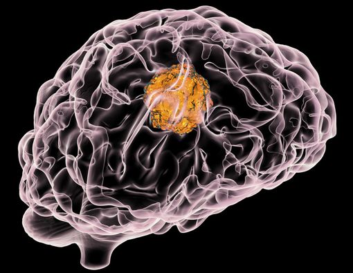 Penyebab Kanker Otak seperti yang Diderita Agung Hercules