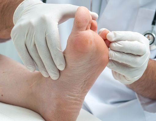 Tidak Bahaya tapi Bisa Menular, Apa Penyebab Kutu Air?