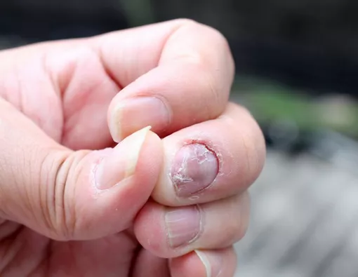 8 Pengobatan Alami untuk Bantu Singkirkan Jamur Kuku