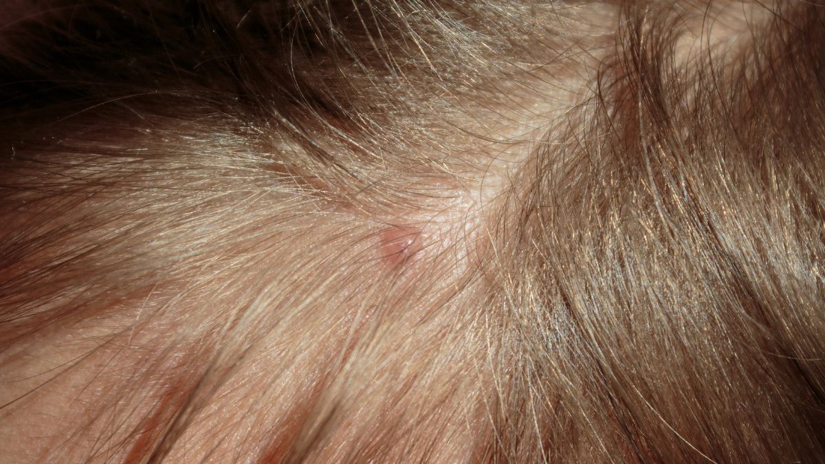 5 Penyebab Munculnya Bisul di Kepala dan Cara Mengatasinya