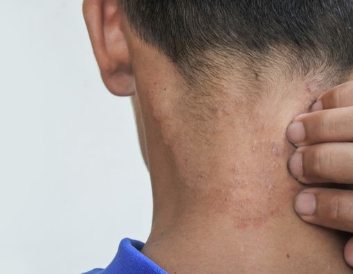 Cara Menghilangkan Kurap di Kulit dengan Bahan Alami