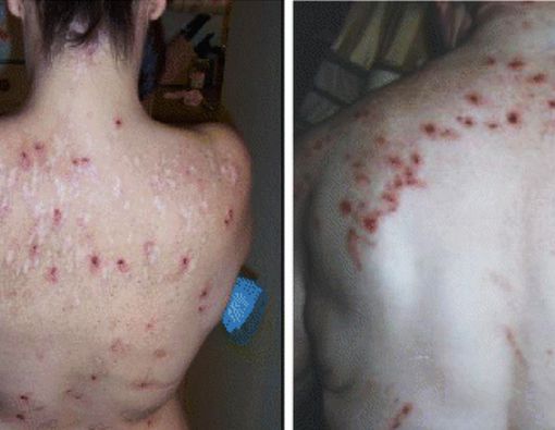 Mengenal Morgellons, Penyakit Kulit Langka yang Misterius