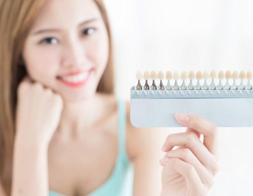 Veneer Gigi Bisa Tahan Berapa Lama? Ini Faktanya