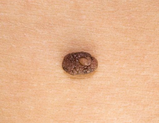 19 Bahan Alami untuk Bantu Menghilangkan Tahi Lalat Secara Alami