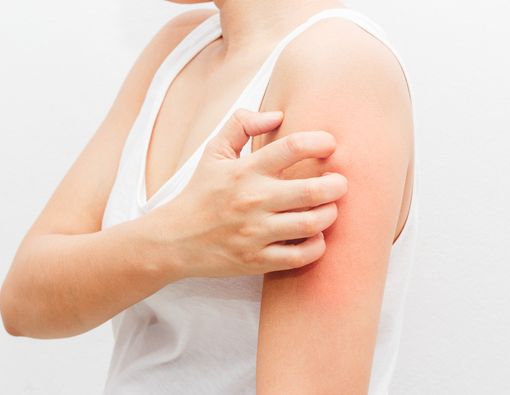 Penyakit Kulit yang Rentan Mewabah di Musim Kemarau